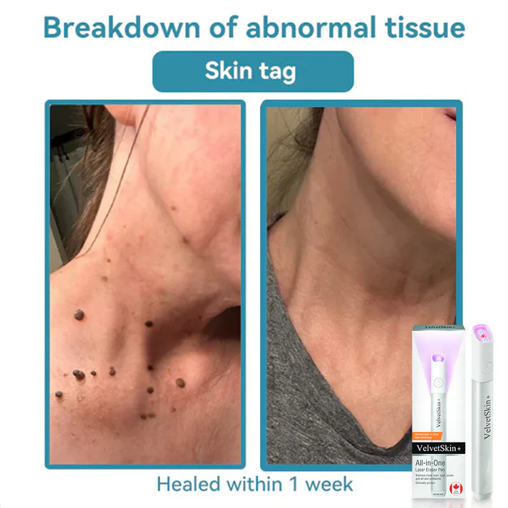All-in-One CO₂ Laser Eraser Pen | Removes Moles. Warts. Skin Flaws & Pigmentation