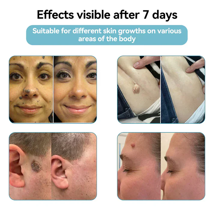 All-in-One CO₂ Laser Eraser Pen | Removes Moles. Warts. Skin Flaws & Pigmentation