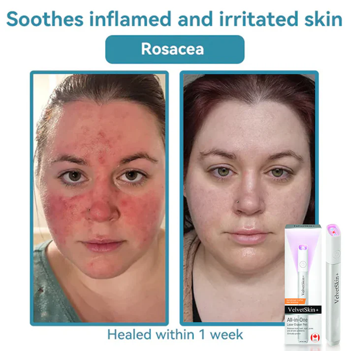 All-in-One CO₂ Laser Eraser Pen | Removes Moles. Warts. Skin Flaws & Pigmentation