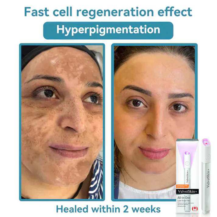 All-in-One CO₂ Laser Eraser Pen | Removes Moles. Warts. Skin Flaws & Pigmentation