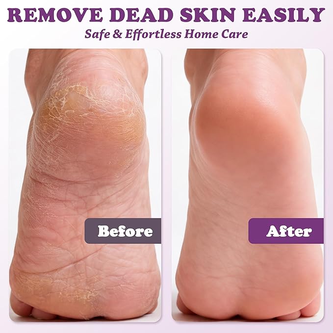 Electric Foot Callus Remover
